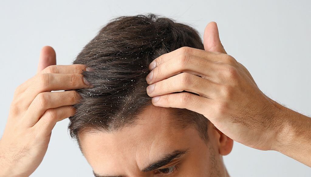 Young man with problem of dandruff on light background, closeup
