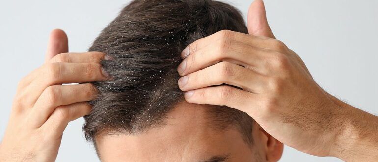 Young man with problem of dandruff on light background, closeup
